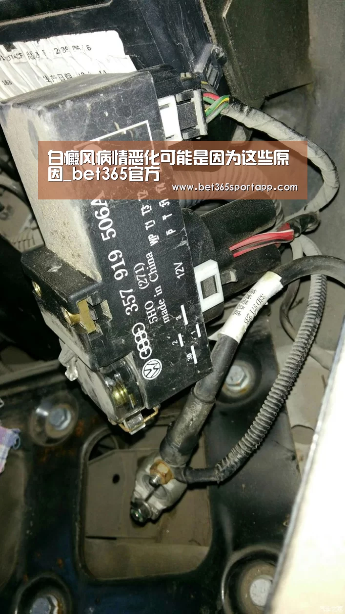白癜风病情恶化可能是因为这些原因_bet365官方(图4) bet365网站